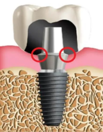 A custom abutment in bone, closing the gap at the gum line