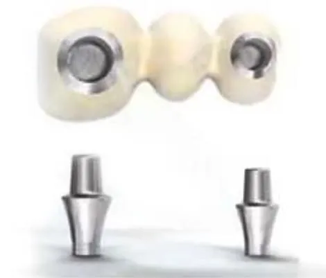 Custom abutments milled to the individual mouth