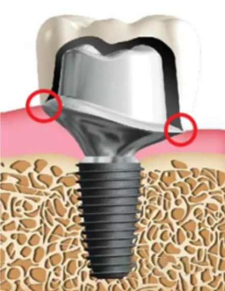 A stock abutment in bone, with the gaps it leaves at the gum line marked