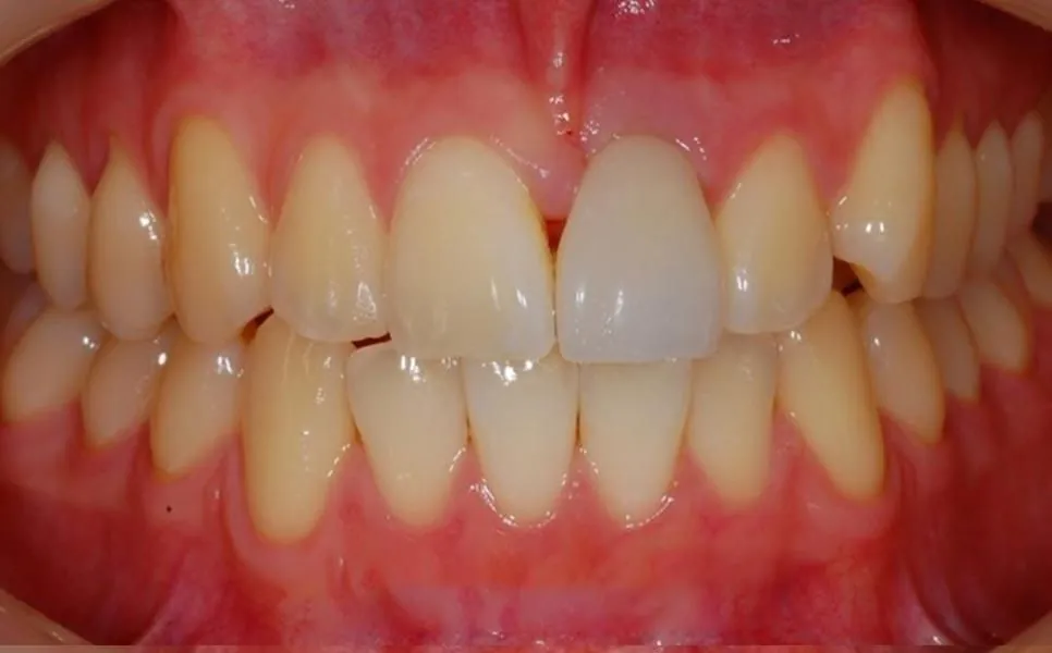 The same upper front after an aesthetic implant