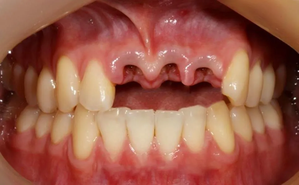 An upper front gap before an aesthetic implant