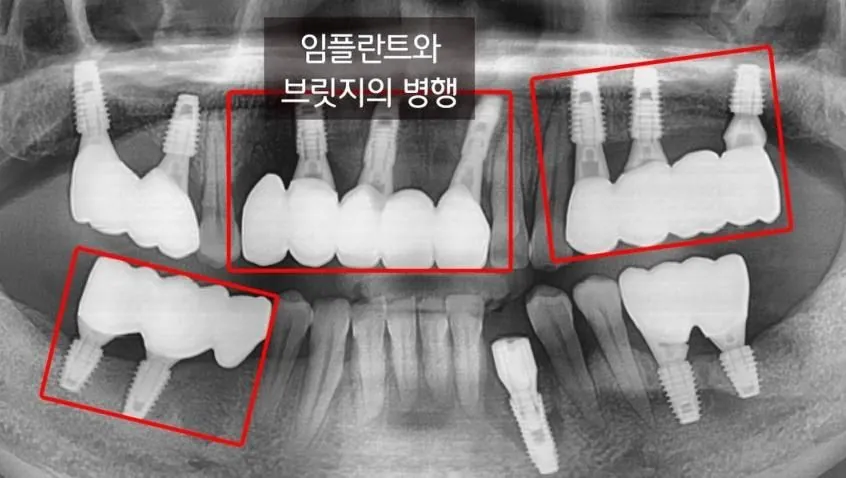 An anterior implant bridge on two fixtures