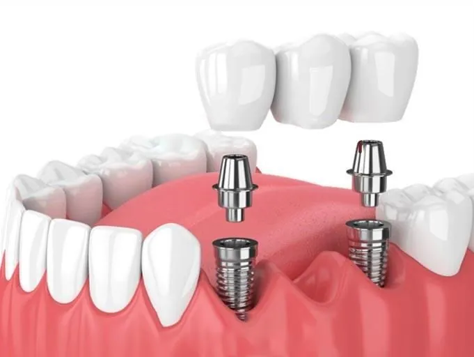 A posterior implant bridge