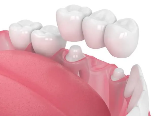 A conventional bridge lowering onto two prepared teeth