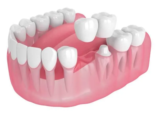 A cantilever bridge carried on a single prepared tooth