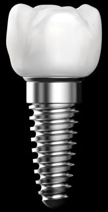 A single implant fixture with its crown
