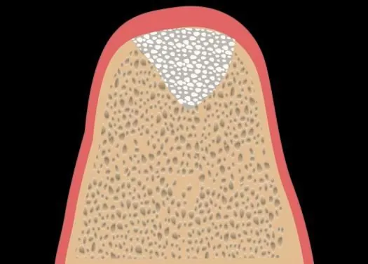 Grade A graft: a small volume of material around a fixture in adequate bone