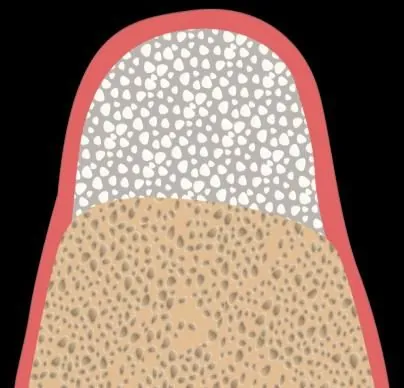 Grade B graft: a larger volume where the defect extends to the neighbouring tooth