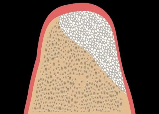 Grade C graft: a wide alveolar defect needing a large volume of material