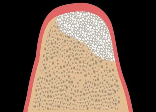 Grade D graft: vertical augmentation, the most demanding of the four