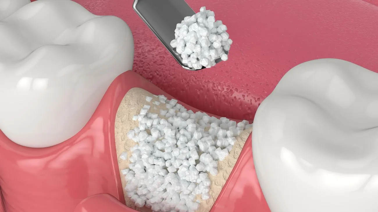 Graft particles being packed into a defect beside an adjacent molar