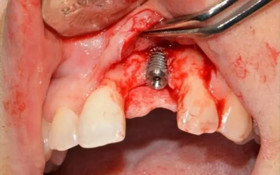 A surgical site opened at the upper front, showing the bone defect