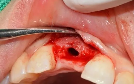 The same site with graft material placed