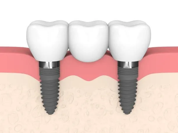 A three-unit implant bridge on two fixtures, seen in section