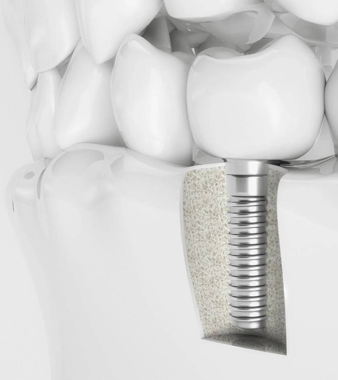 A single implant shown as crown, abutment and fixture