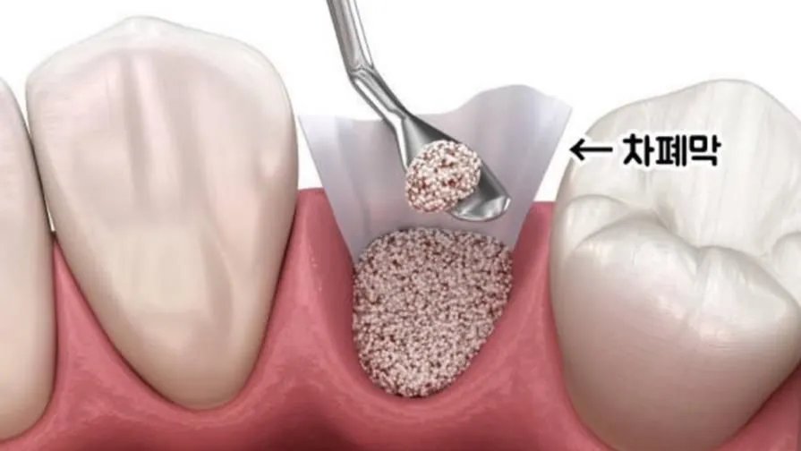 A resorbable membrane laid over packed graft particles