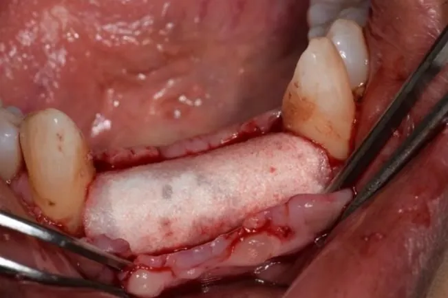 A surgical view of graft material and fixation screws before the membrane goes on