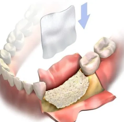Where the membrane sits relative to the graft and the flap