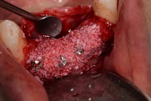 The membrane being tucked under the flap at the end of the procedure