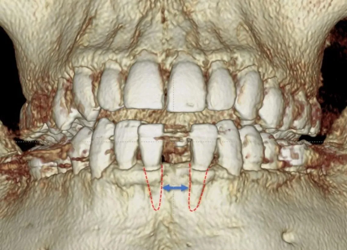 Mini implant fixtures beside a scan of a narrow ridge