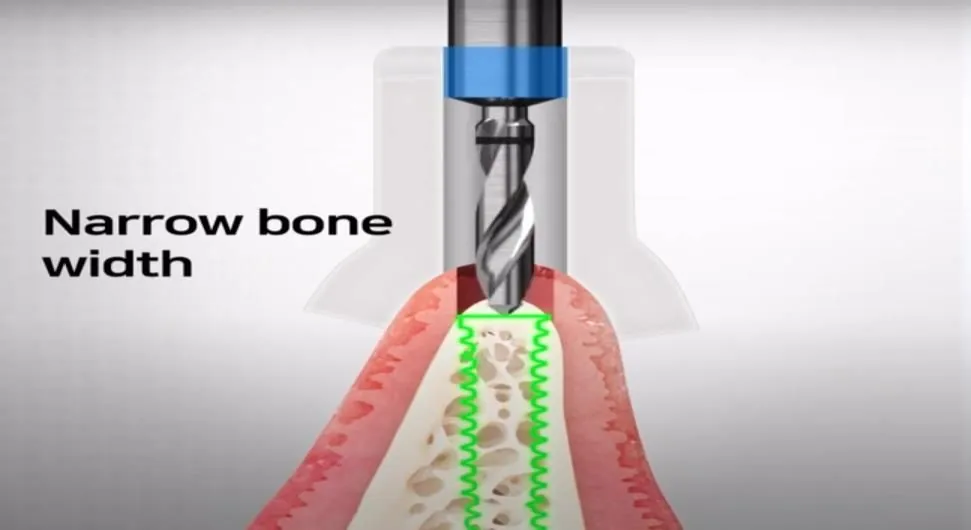 Drilling into a narrow ridge where a standard fixture will not fit