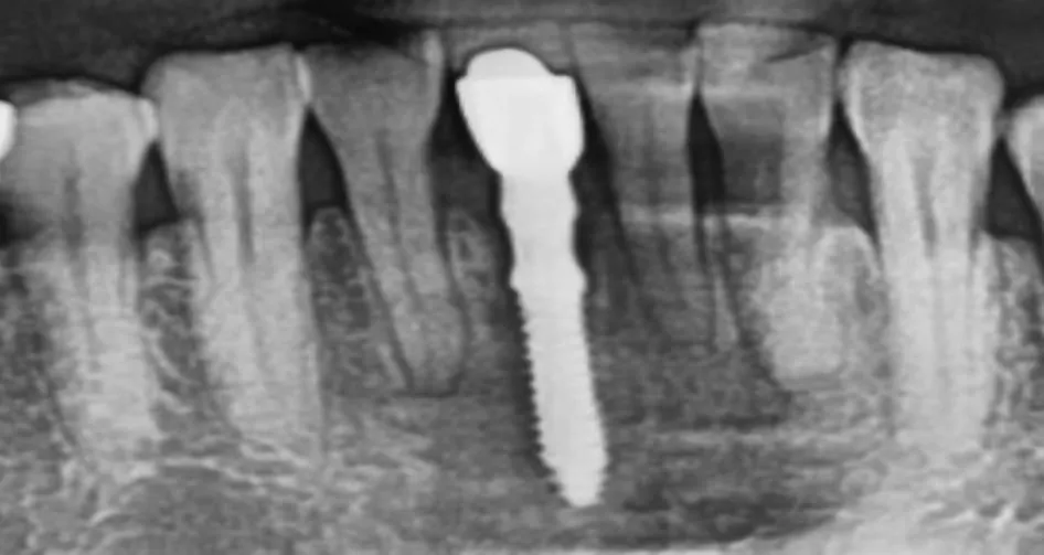 Radiograph after a mini implant is placed