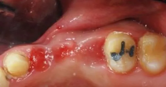 A full-arch guided case, from bare ridge to seated fixtures