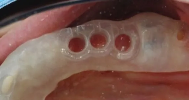 A guided case fitted with a functional temporary
