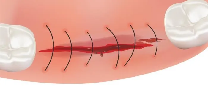 A conventional flap, laid open and sutured