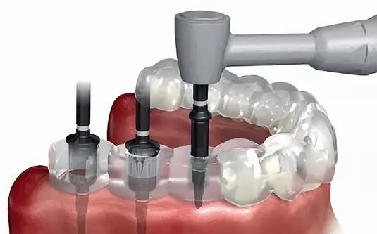 A surgical guide in the mouth, with the drill running through its sleeve