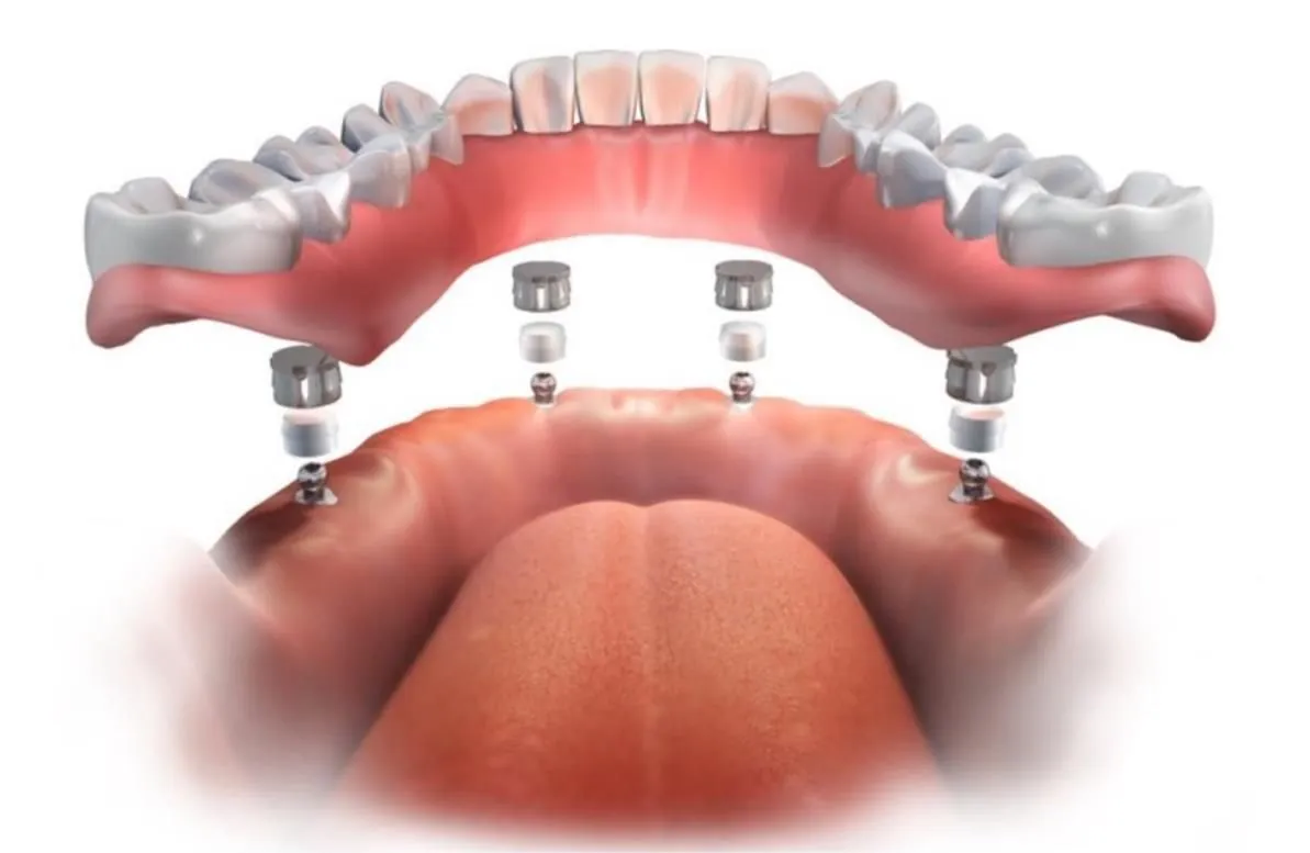 An overdenture held by four fixtures