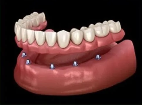 An overdenture seated on the lower arch