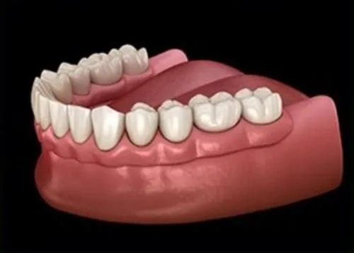 The same overdenture from the side