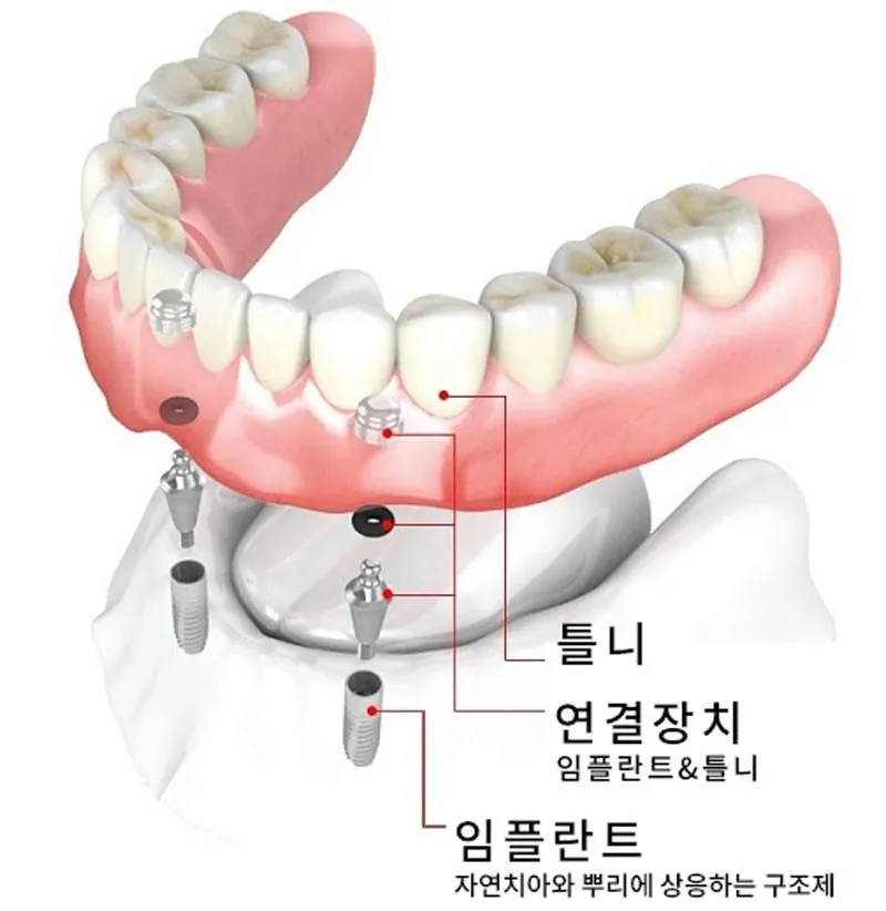 How the denture, the attachment and the fixture connect