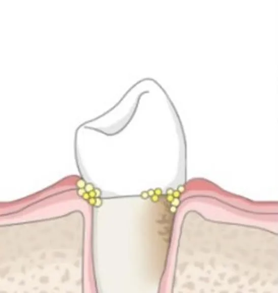 Periodontal treatment, stage one: calculus above the gum line