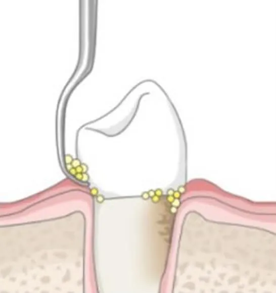 Periodontal treatment, stage two: calculus below the gum line