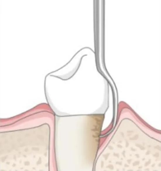 Periodontal treatment, stage three: the cleaned root surface