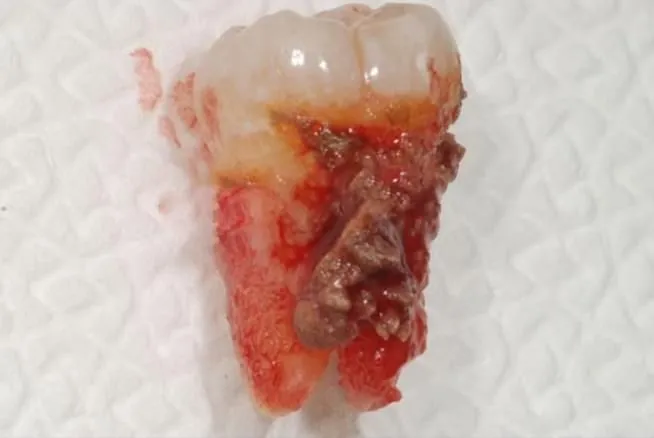 A tooth extracted because of periodontal disease