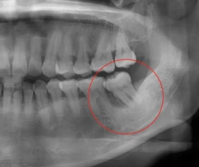 Radiograph before extraction, with the affected area circled