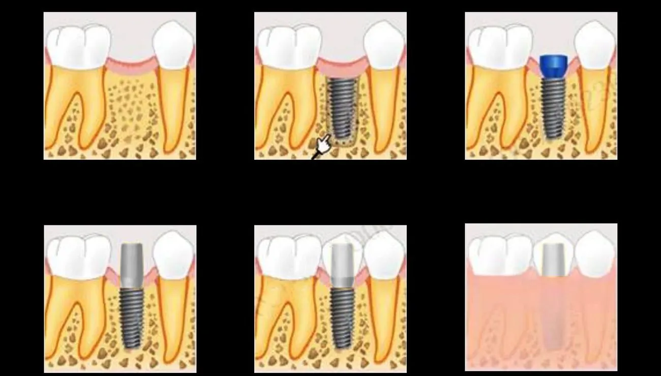 The six stages of an implant, from the lost tooth to the seated crown