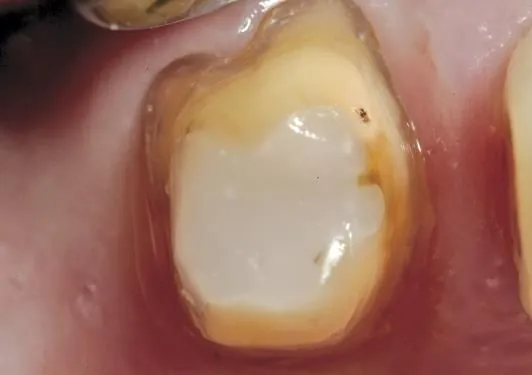 A resin core built into a tooth after root canal treatment