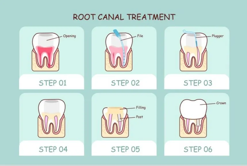 The six steps of root canal treatment