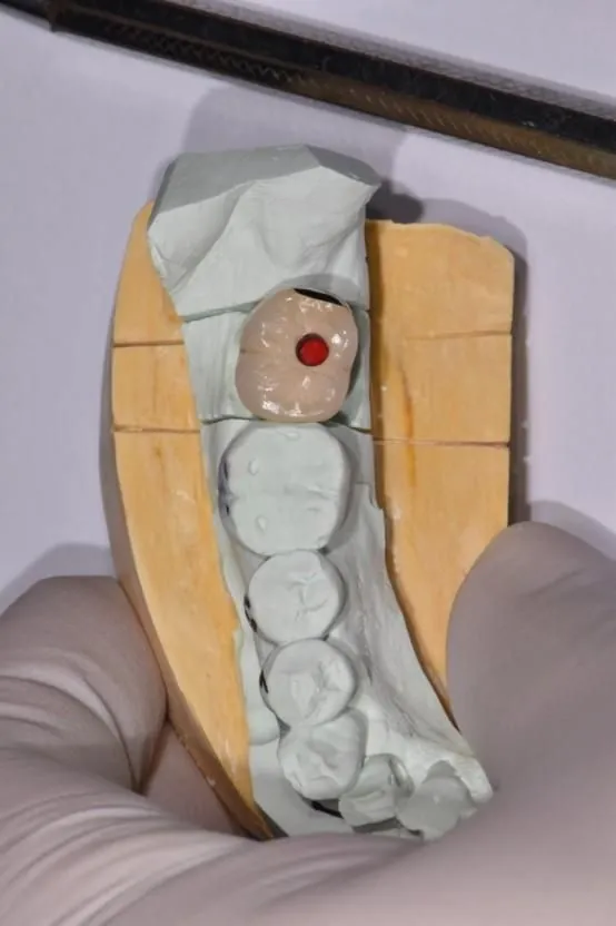 The screw access hole on the biting surface of an implant crown