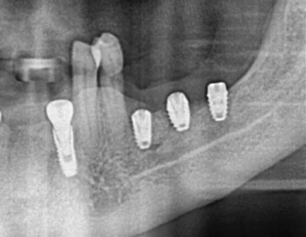 A short fixture beside a standard one, and a radiograph showing the nerve canal