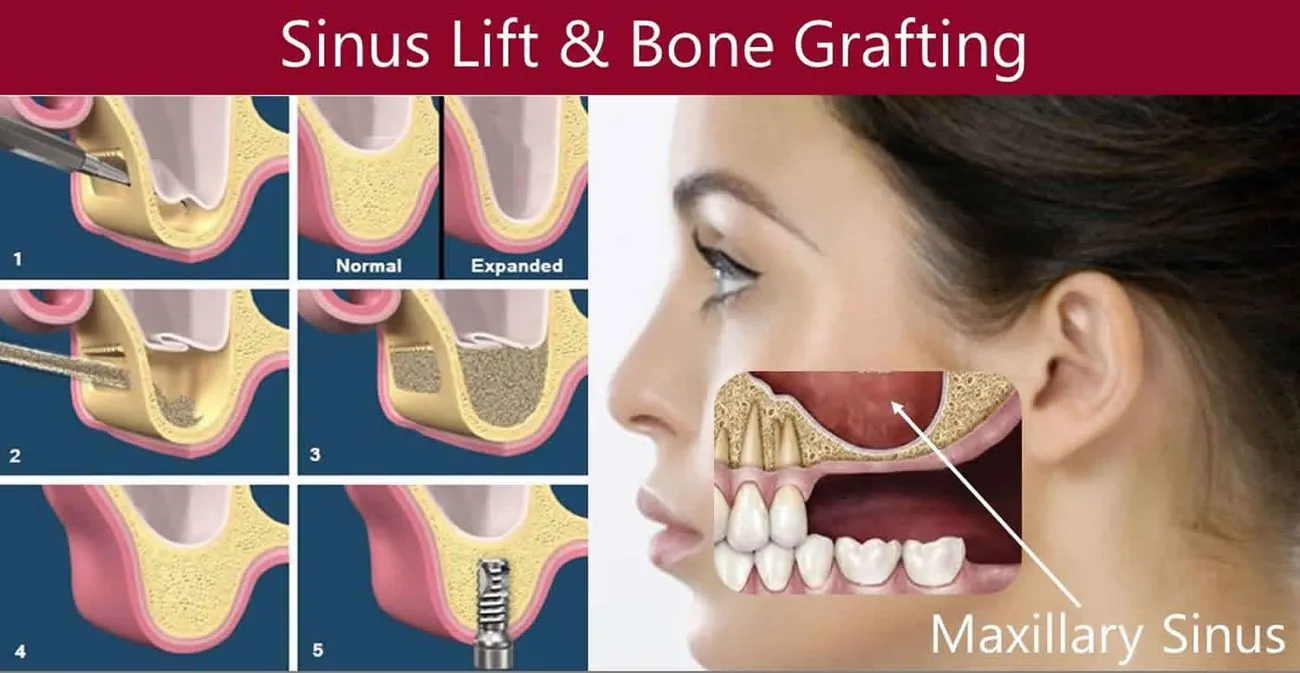 A step chart of sinus lift and bone grafting, with the maxillary sinus marked on a profile