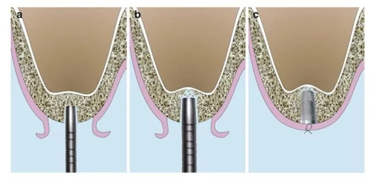 Three stages of a crestal sinus lift shown in section