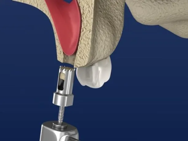Crestal approach, step one: the osteotome enters along the old root axis