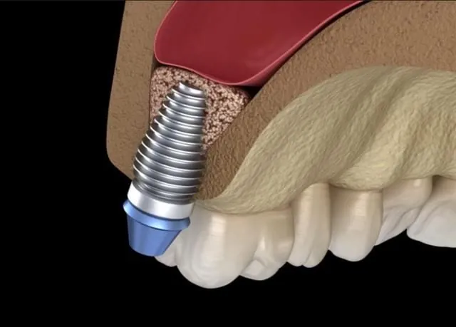 Crestal approach, step two: the sinus membrane is lifted and graft placed