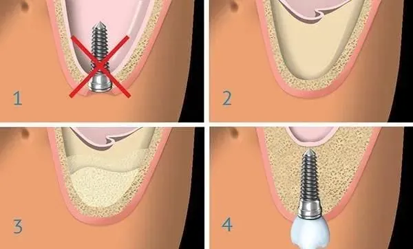 Why a fixture cannot be placed without lifting the sinus, in four panels