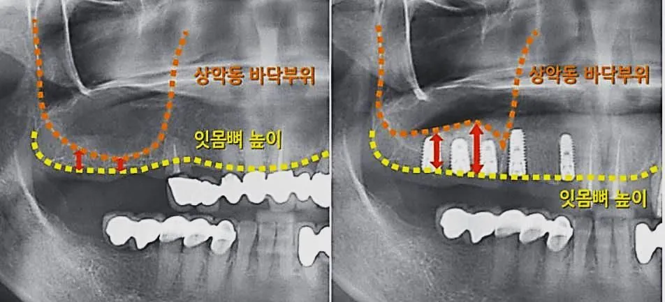 Radiographs before and after the sinus floor is raised